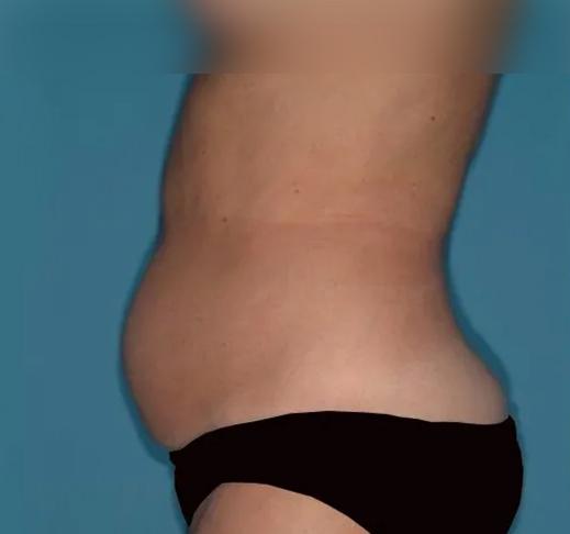 Tummy Tuck before at Crispin Plastic Surgery in Atlanta, GA