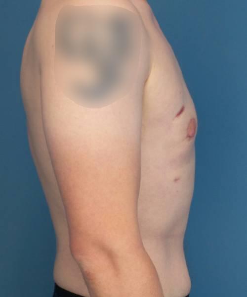 Gynecomastia Surgery after at Crispin Plastic Surgery in Atlanta, GA