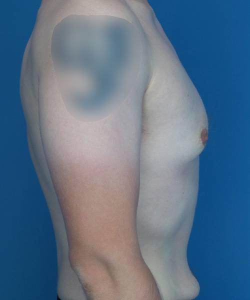 Gynecomastia Surgery before at Crispin Plastic Surgery in Atlanta, GA