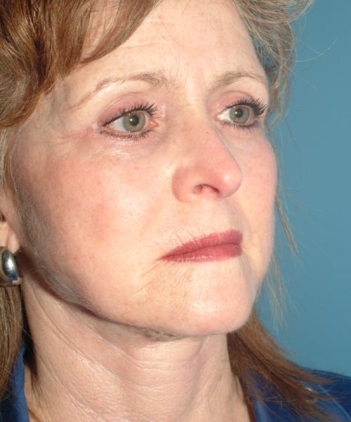 Crispin Plastic Surgery facelift after — Atlanta, GA