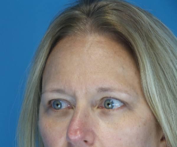 Crispin Plastic Surgery blepharoplasty after — Atlanta, GA