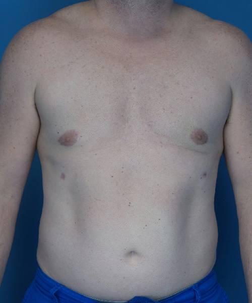 Crispin Plastic Surgery gynecomastia after — Atlanta, GA