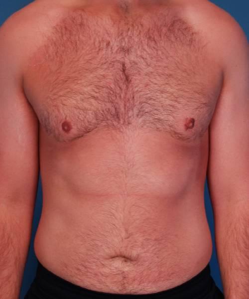 Crispin Plastic Surgery gynecomastia after — Atlanta, GA