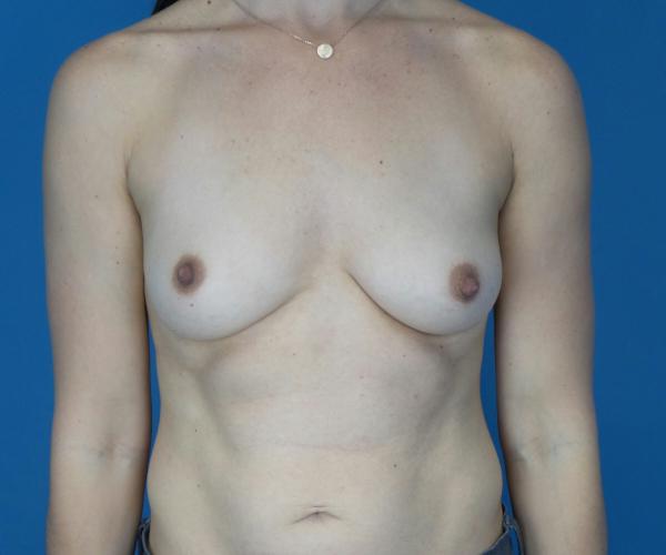 Breast Augmentation before at Crispin Plastic Surgery in Atlanta, GA