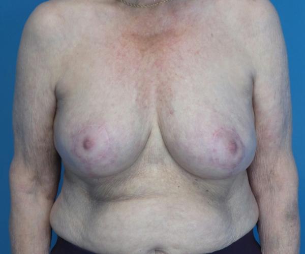 Crispin Plastic Surgery breast reduction after — Atlanta, GA