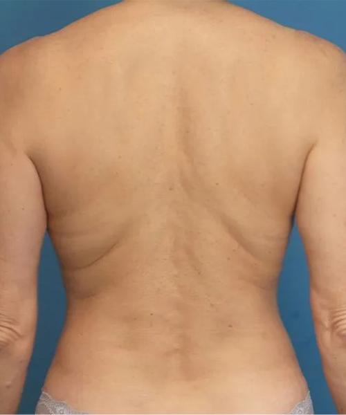 Crispin Plastic Surgery liposuction after — Atlanta, GA