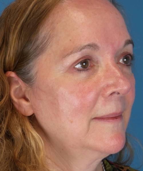 Crispin Plastic Surgery blepharoplasty after — Atlanta, GA