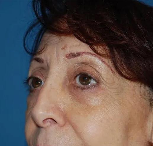 Blepharoplasty after at Crispin Plastic Surgery in Atlanta, GA