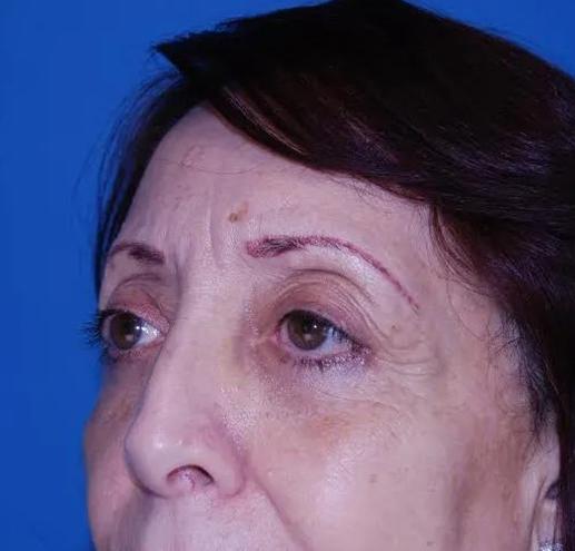 Blepharoplasty before at Crispin Plastic Surgery in Atlanta, GA
