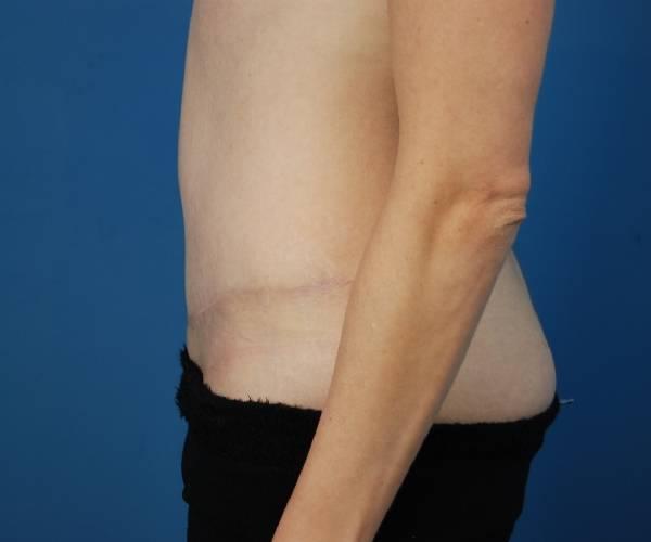 Tummy Tuck after at Crispin Plastic Surgery in Atlanta, GA