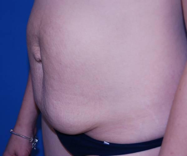 Tummy Tuck before at Crispin Plastic Surgery in Atlanta, GA
