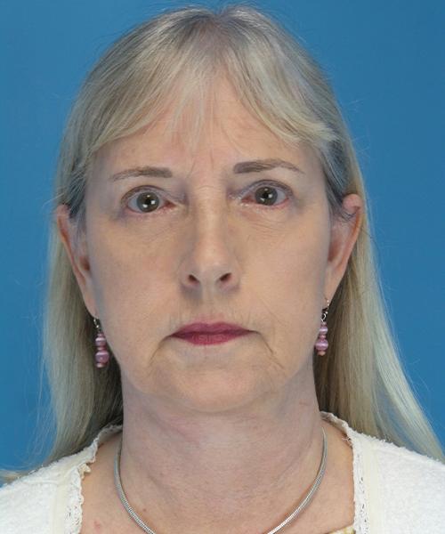 Crispin Plastic Surgery facelift after — Atlanta, GA