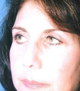 Crispin Plastic Surgery blepharoplasty result