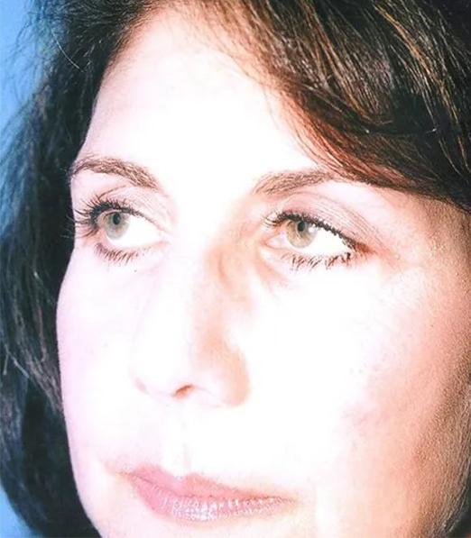 Blepharoplasty after at Crispin Plastic Surgery in Atlanta, GA