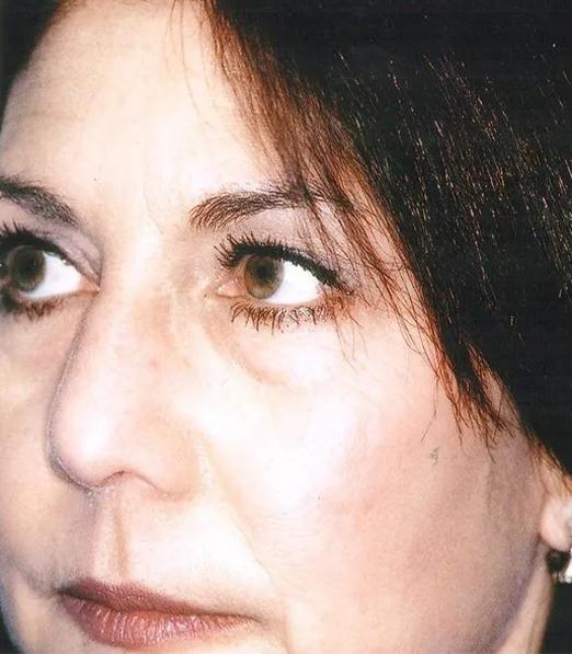 Blepharoplasty before at Crispin Plastic Surgery in Atlanta, GA
