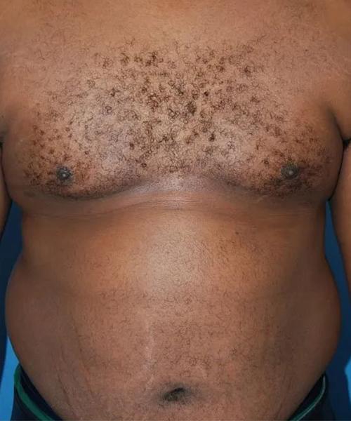 Gynecomastia Surgery after at Crispin Plastic Surgery in Atlanta, GA