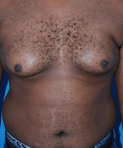 Gynecomastia Surgery before at Crispin Plastic Surgery in Atlanta, GA