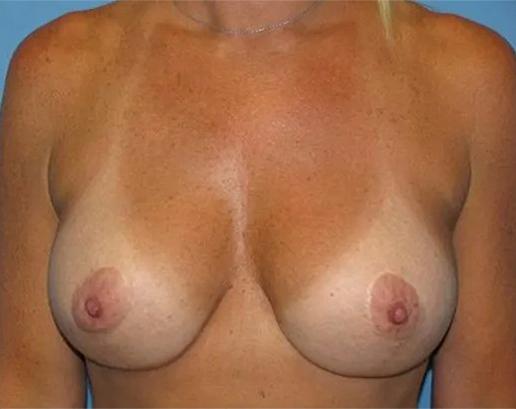 Breast Lift after at Crispin Plastic Surgery in Atlanta, GA