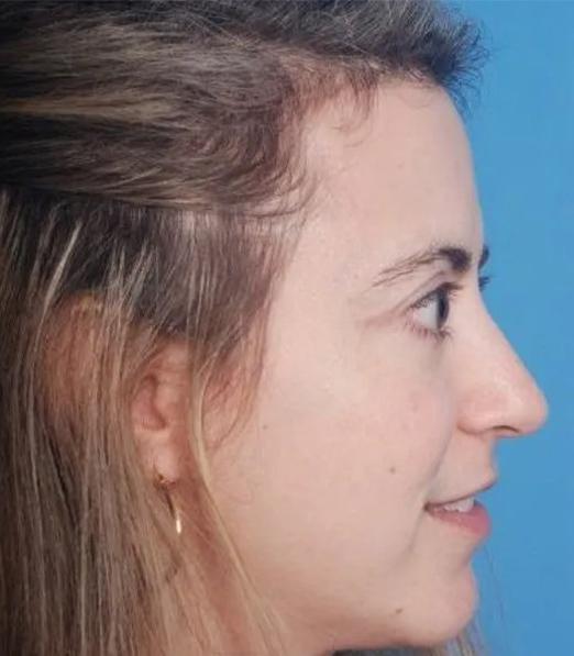 Crispin Plastic Surgery blepharoplasty after — Atlanta, GA