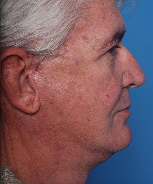 Facelift after at Crispin Plastic Surgery in Atlanta, GA