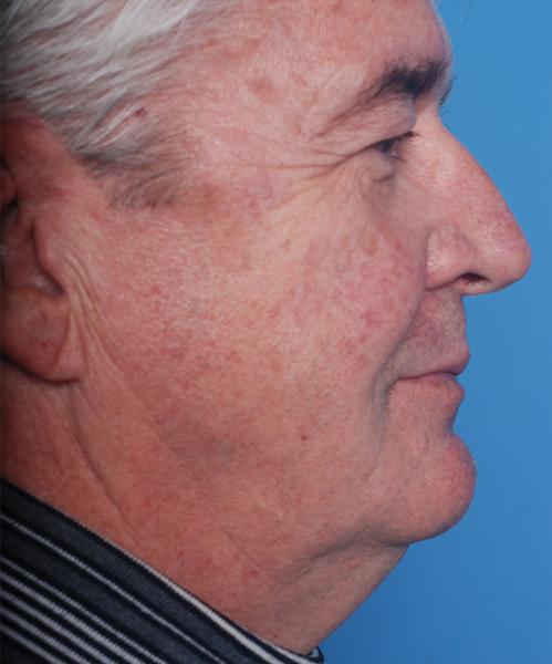 Facelift before at Crispin Plastic Surgery in Atlanta, GA