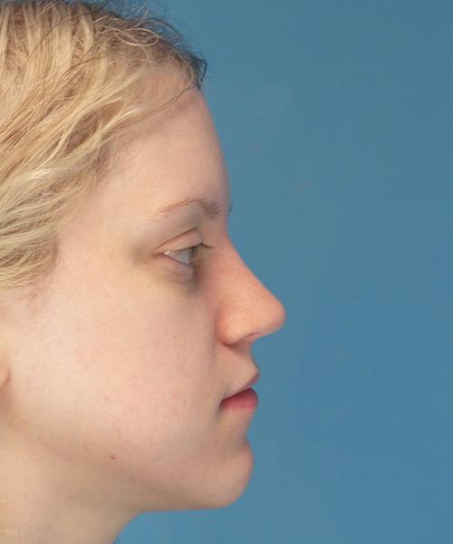 Ethnic Rhinoplasty after at Crispin Plastic Surgery in Atlanta, GA