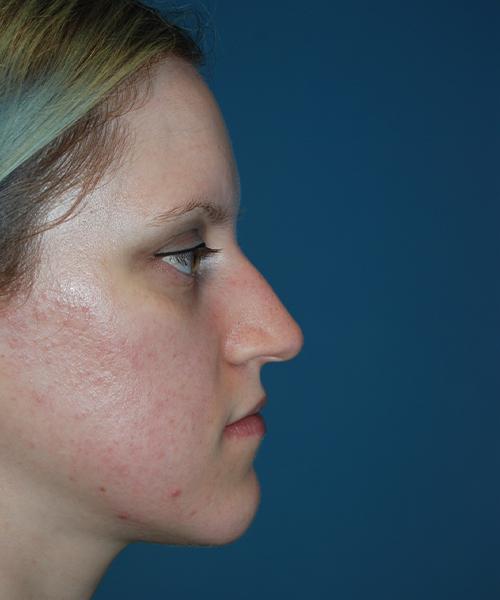 Ethnic Rhinoplasty before at Crispin Plastic Surgery in Atlanta, GA