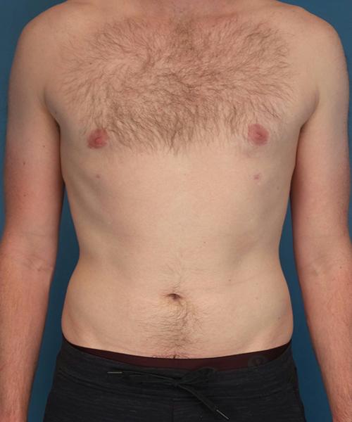 Crispin Plastic Surgery gynecomastia after — Atlanta, GA