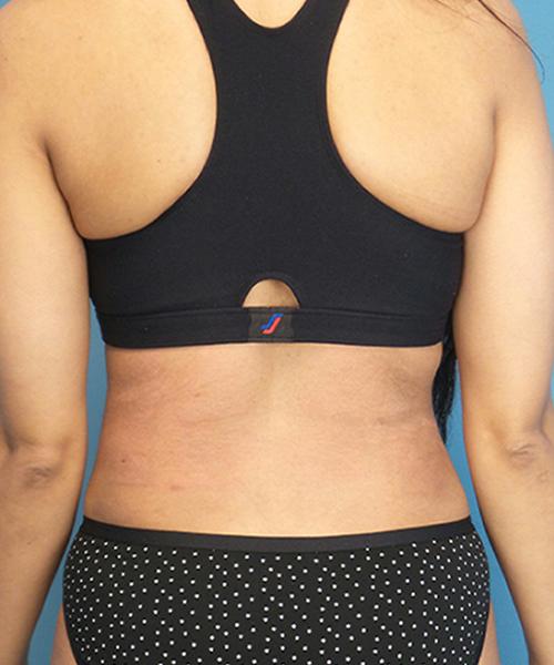 Crispin Plastic Surgery liposuction after — Atlanta, GA