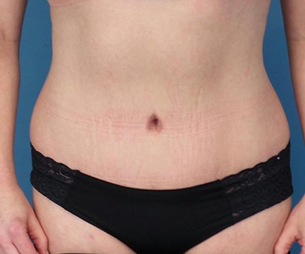 Crispin Plastic Surgery tummy tuck after — Atlanta, GA