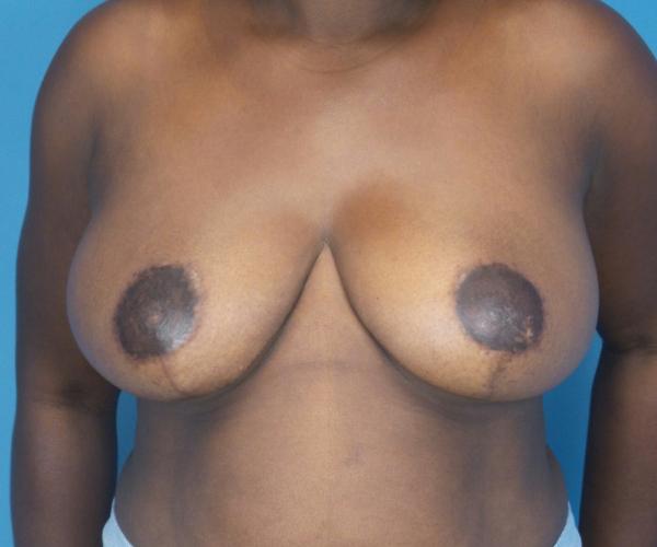 Crispin Plastic Surgery breast reduction after — Atlanta, GA