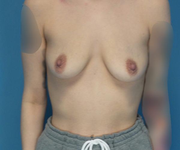 Breast Lift before at Crispin Plastic Surgery in Atlanta, GA