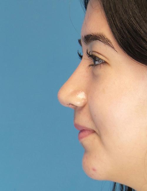 Crispin Plastic Surgery rhinoplasty after — Atlanta, GA