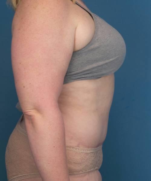 Crispin Plastic Surgery tummy tuck after — Atlanta, GA