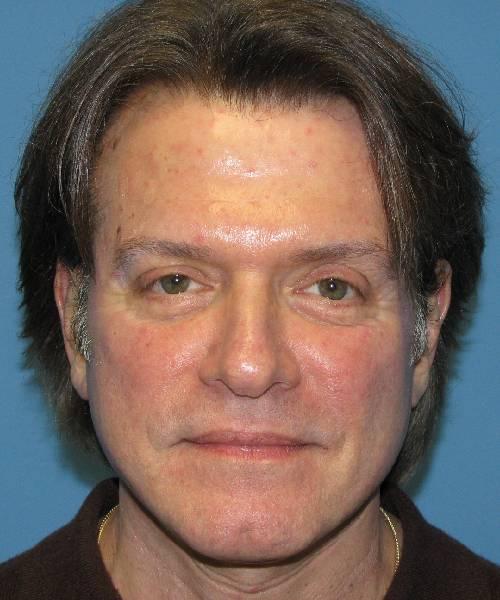 Crispin Plastic Surgery facelift after — Atlanta, GA