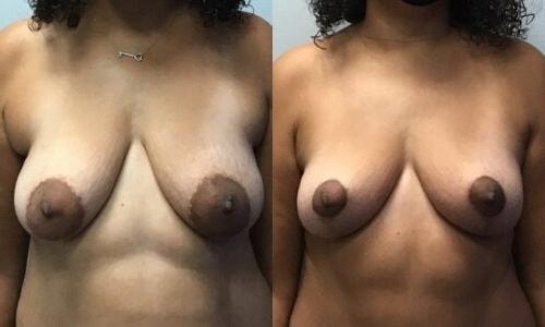 Martin J. Moskovitz, MD, FACS breast lift result — Paramus, NJ