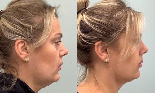 Martin J. Moskovitz, MD, FACS neck liposuction result — Paramus, NJ