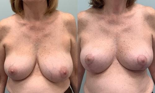 Martin J. Moskovitz, MD, FACS breast lift result — Paramus, NJ
