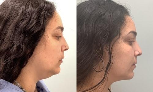 Martin J. Moskovitz, MD, FACS neck liposuction result — Paramus, NJ