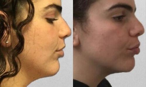 Martin J. Moskovitz, MD, FACS neck liposuction result — Paramus, NJ