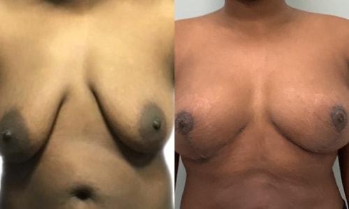 Martin J. Moskovitz, MD, FACS breast lift result — Paramus, NJ
