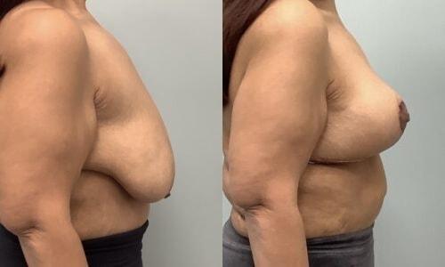 Martin J. Moskovitz, MD, FACS breast lift result — Paramus, NJ
