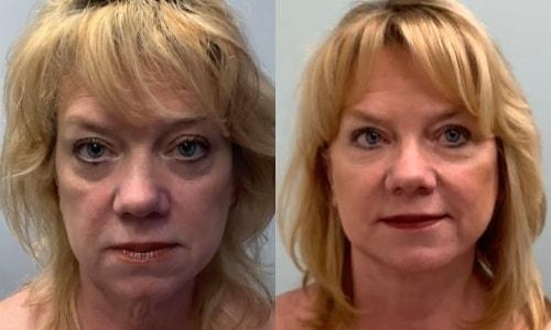 Martin J. Moskovitz, MD, FACS facelift result — Paramus, NJ