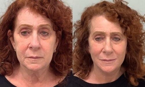 Martin J. Moskovitz, MD, FACS facelift result — Paramus, NJ