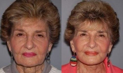 Martin J. Moskovitz, MD, FACS facelift result — Paramus, NJ
