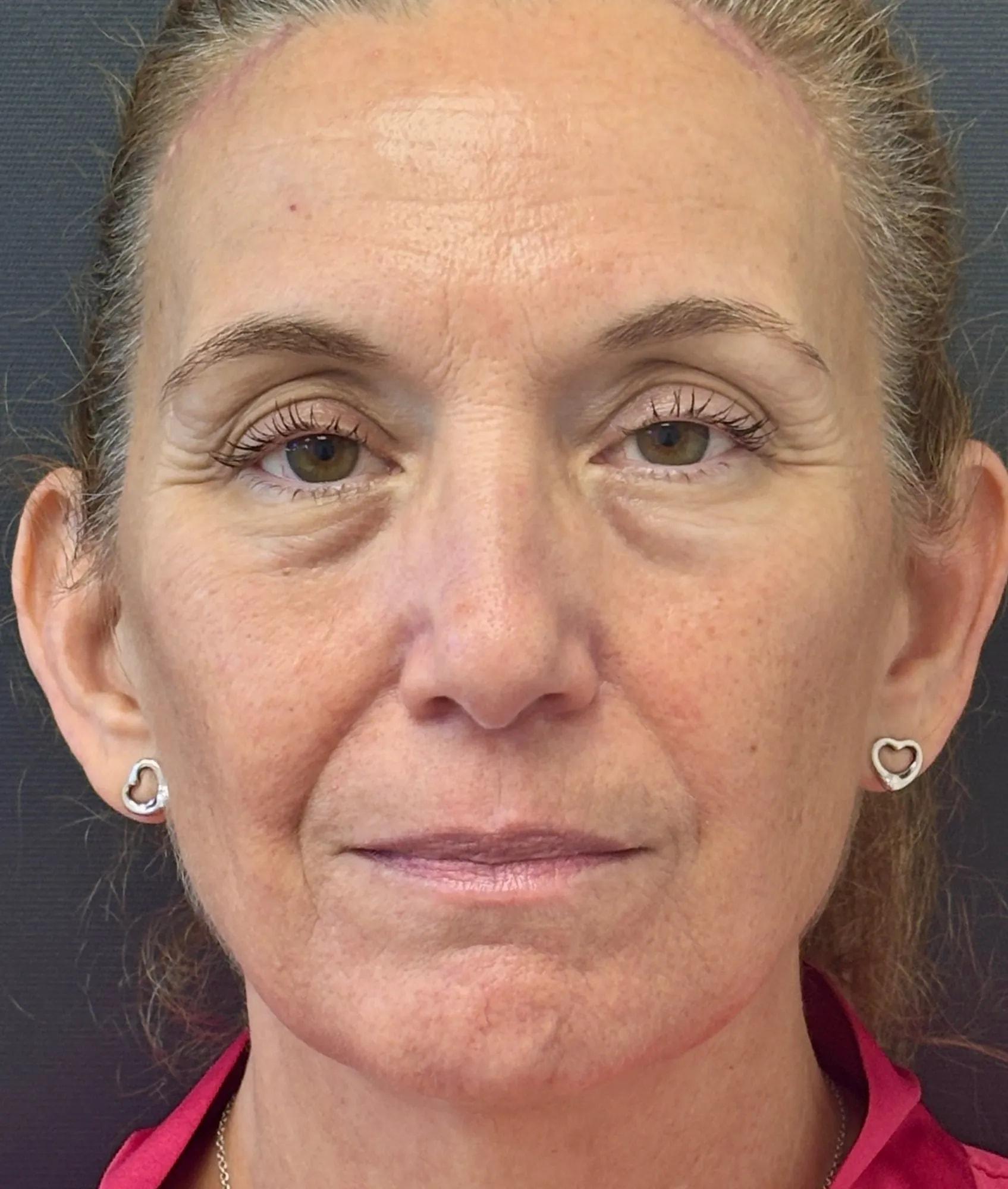 Poris Plastic Surgery brow lift after — Winter Park, FL