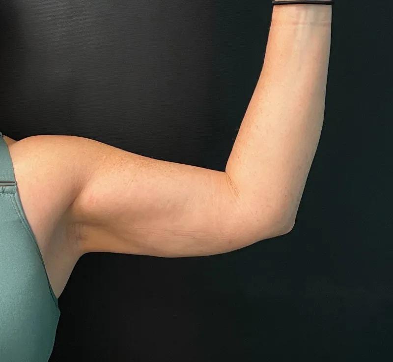 Poris Plastic Surgery arm lift after — Winter Park, FL