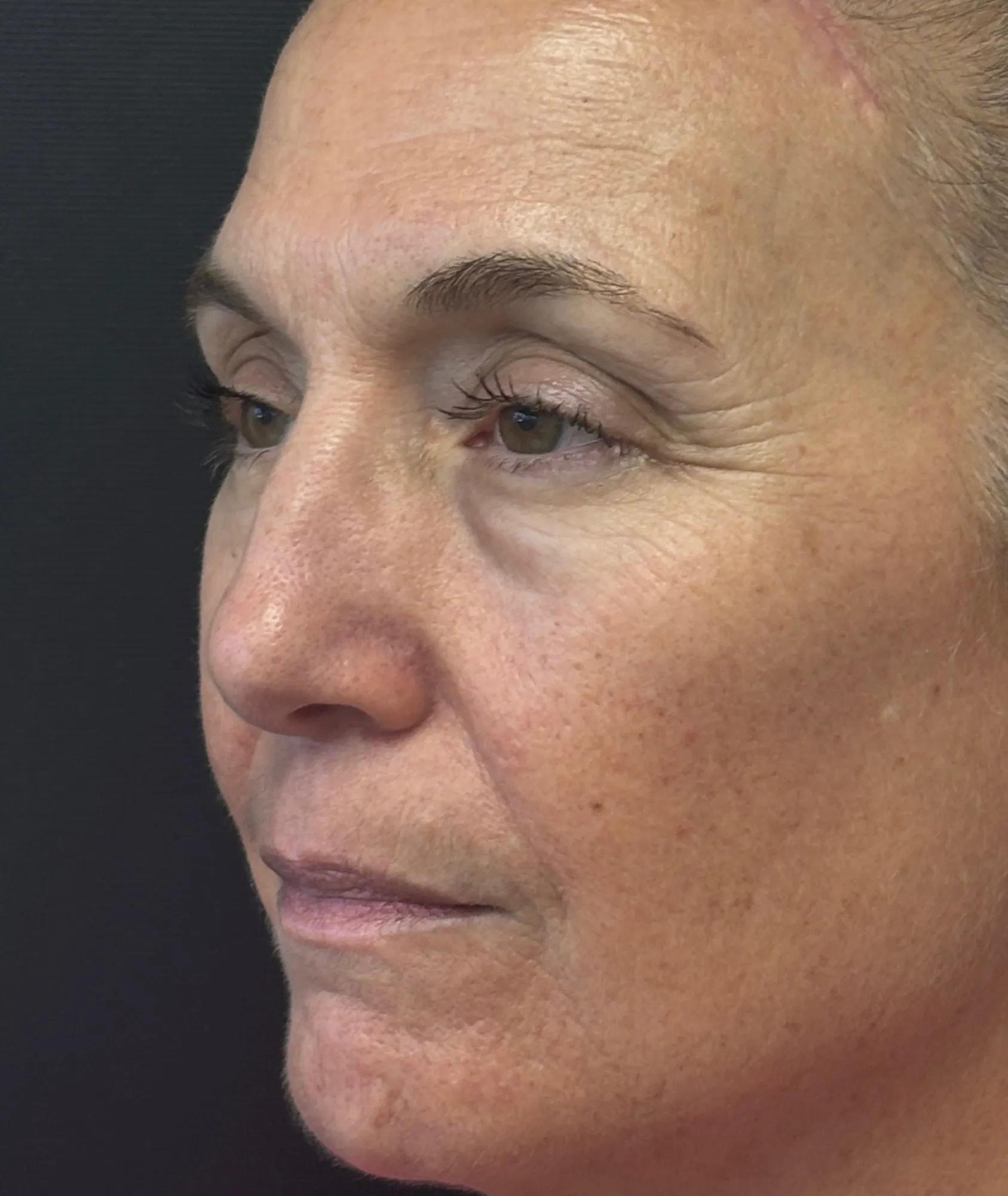 Poris Plastic Surgery brow lift after — Winter Park, FL
