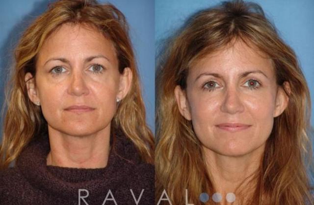 Blepharoplasty result at Raval Facial Aesthetics in Denver, CO