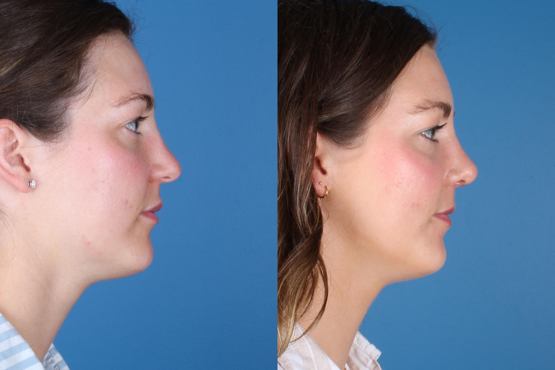 Raval Facial Aesthetics rhinoplasty result — Denver, CO